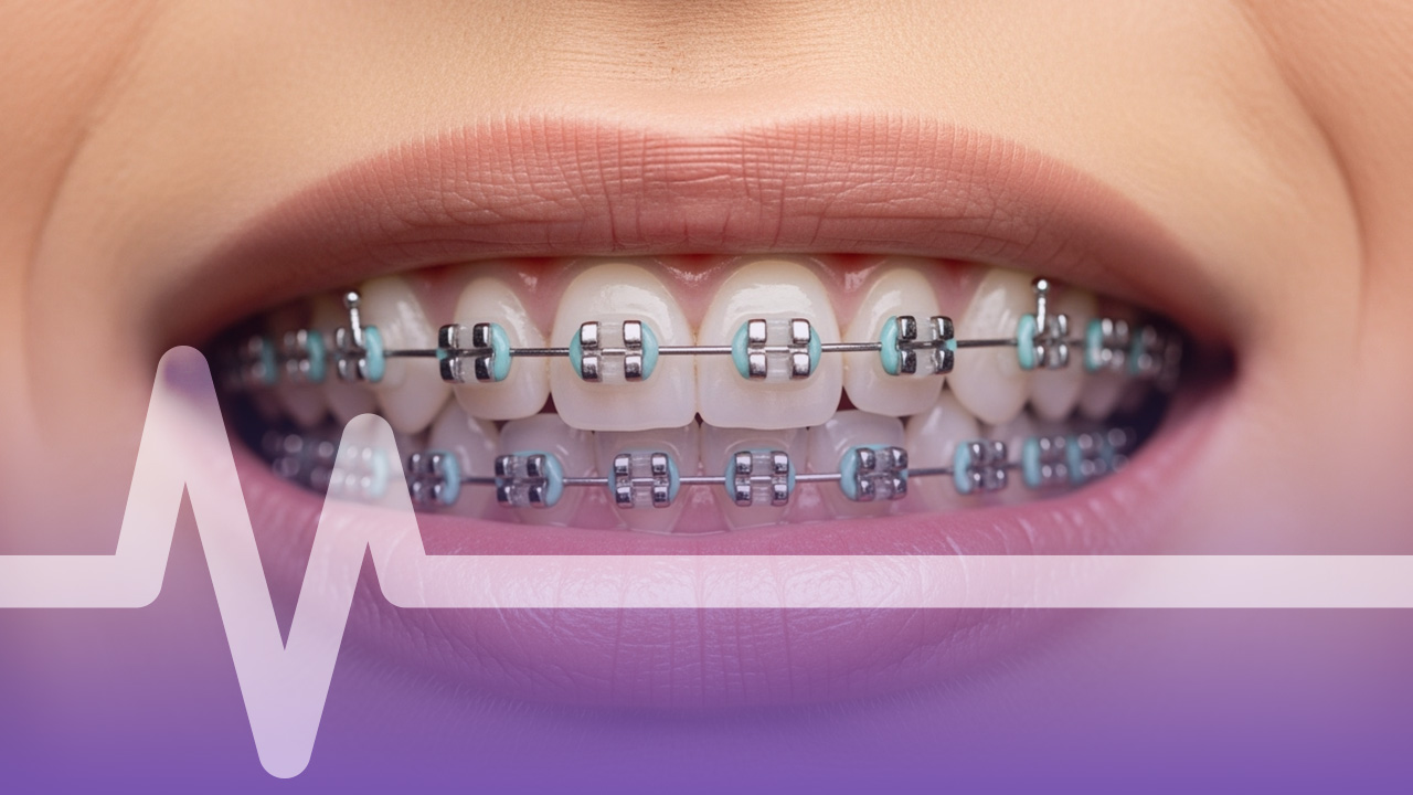 افضل سن لعمل تقويم الاسنان